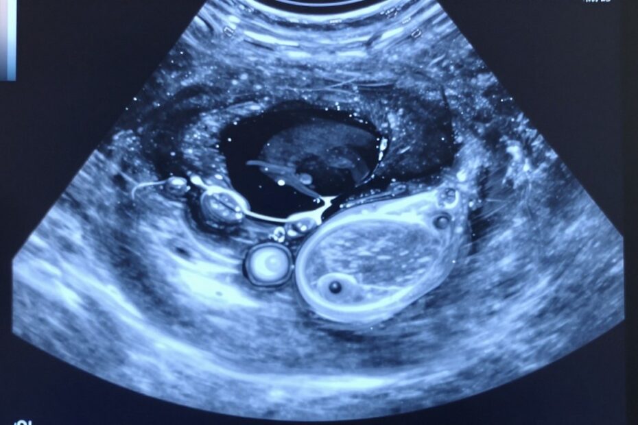 Torbiel na jajniku USG