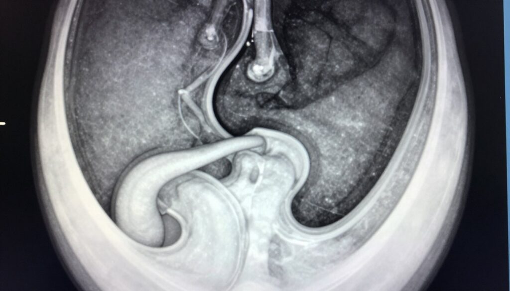A detailed radiographic image of a hiatal hernia, highlighting the esophagus and diaphragm with contrast media clearly visible. In the foreground, show the esophagus and its anatomical features prominently, with smooth lines illustrating the upper digestive tract. In the middle ground, depict the diaphragm's contour, showcasing the hernial sac bulging through the esophageal hiatus. The background should feature a soft gradient that enhances the focus on the medical image, with subtle indications of medical equipment to give context. The lighting should be bright and clinical, mimicking an X-ray room setting. Convey a professional atmosphere, suitable for a medical publication, while maintaining clarity and depth for educational purposes.